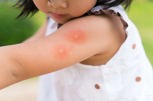 Mușcăturile de țânțari la copii