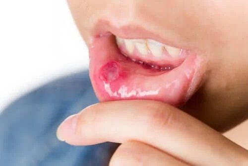 Persoană cu ulcer bucal