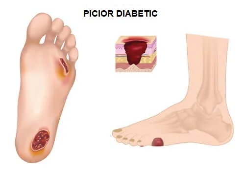 Picior diabetic cu leziuni