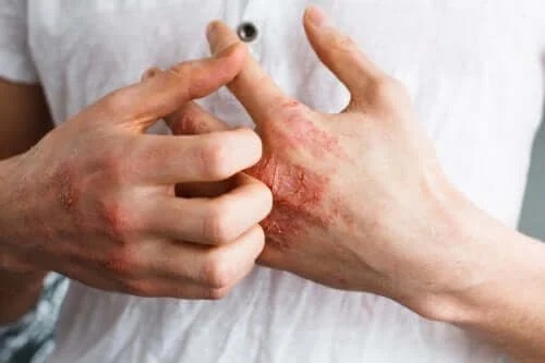 Persoană cu psoriazis