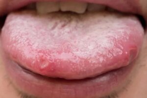 Remedii pentru candidoza orală: alternative naturale