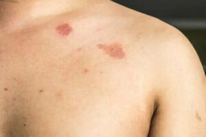 Descrierea și caracteristicile pitiriazisului versicolor