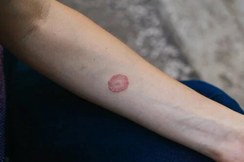 Infecție fungică pe piele