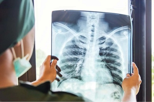 Medic ce planifică transplantul de plămâni