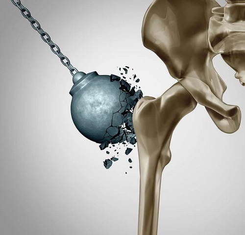 Osteoporoza după menopauză: cum reduci daunele?