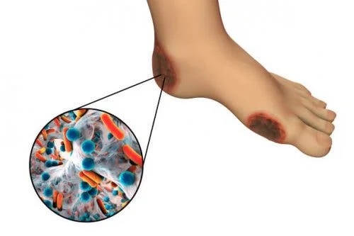 Picior cu gangrenă
