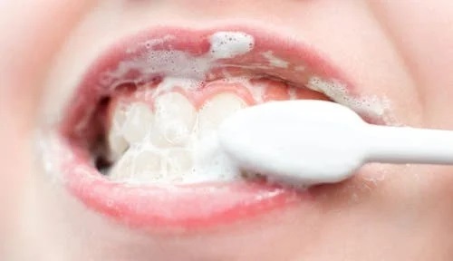 Procedurile de albire a dinților acasă