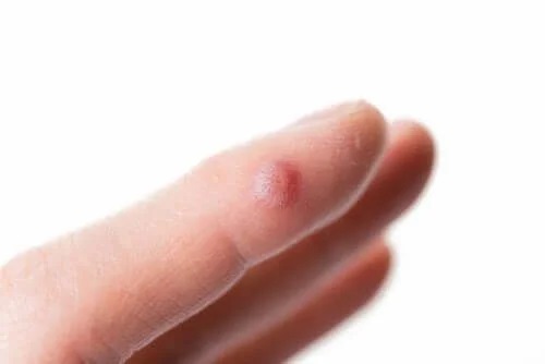 Pustule provocate de sindromul Hallopeau