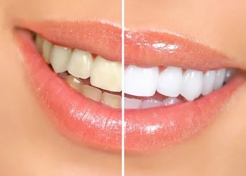 Rezultate la procedurile de albire a dinților