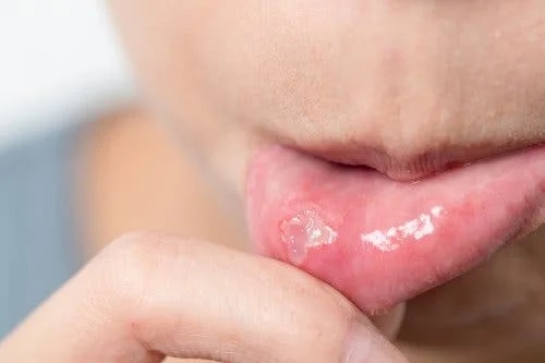 5 tratamente pentru aftele bucale
