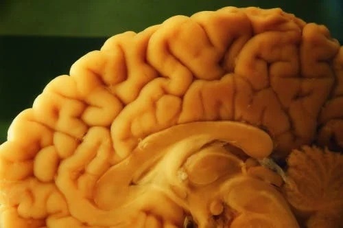 Creier examinat la autopsia neuropatologică