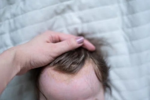 Crusta de lapte pe scalp
