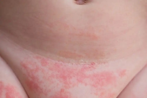 Dermatita la copii
