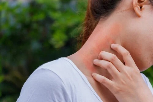 Dermatita și corticosteroizii: ce relație există?