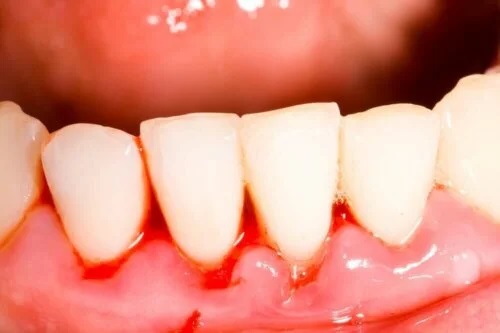 Dinți afectați de gura de tranșee