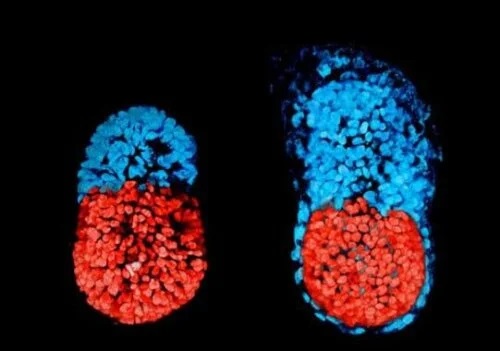 Embrioni fetus in fetu