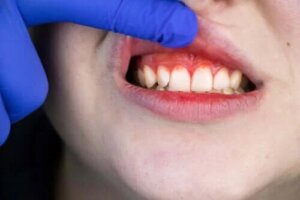 Gingivita ulcerativă necrotizantă acută: tratament