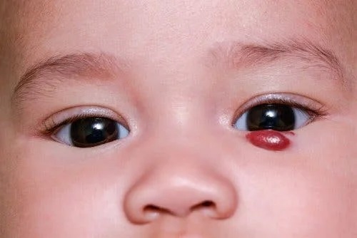 Ce sunt hemangioamele infantile?