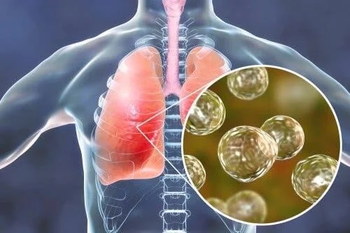 Infecție în plămâni