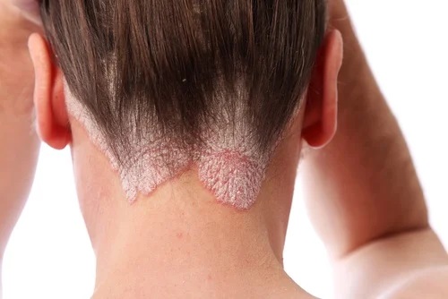 Psoriazis pe scalp