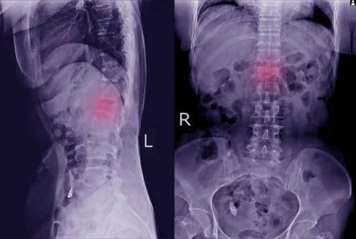 Radiografie a spatelui