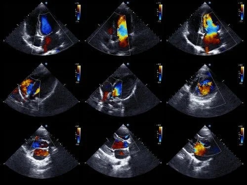 Revărsatul pericardic văzut la ecografie