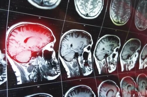 RMN cerebral