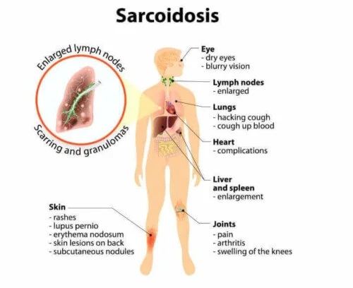 Simptome și tratament pentru sarcoidoză