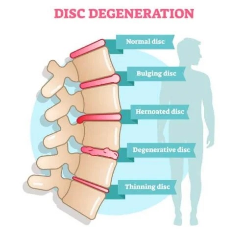 Simptomele bolii degenerative discale
