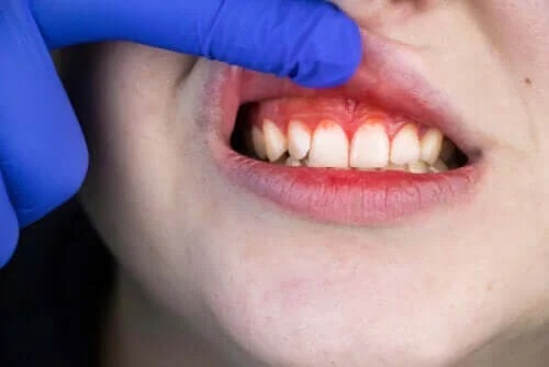 Originea, simptomele și tratamentul gurii de tranșee