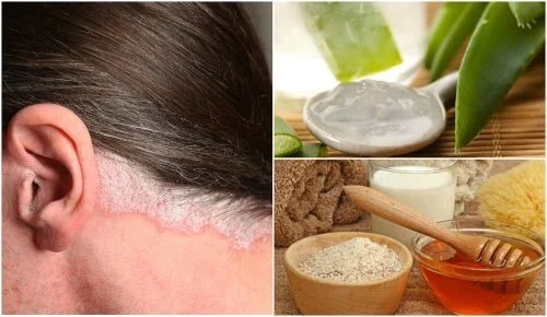 Tratamentul psoriazisului scalpului în mod natural