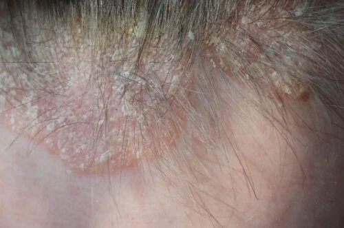 Simptomele și tratamentul psoriazisului scalpului