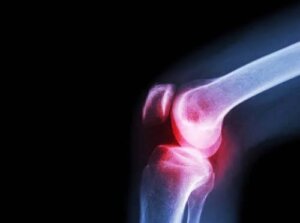 Cauzele, simptomele și tratamentul artritei septice