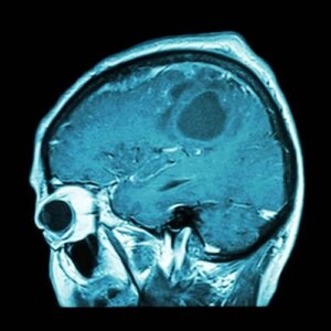 Când va apărea vaccinul contra cancerului cerebral?