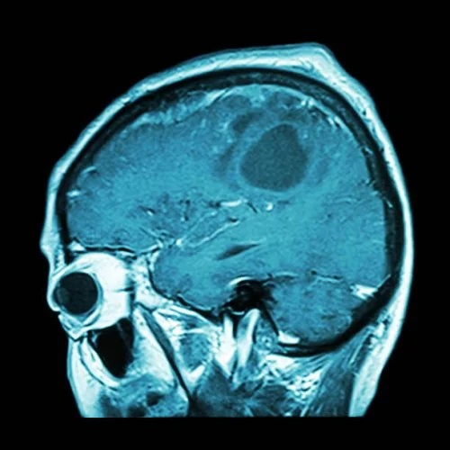 Când va apărea vaccinul contra cancerului cerebral?