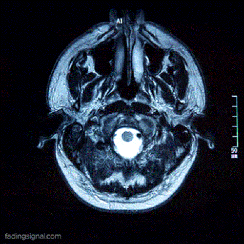 Curiozități despre creierul uman văzute la RMN