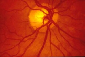 Dezlipirea de retină: intervenția chirurgicală