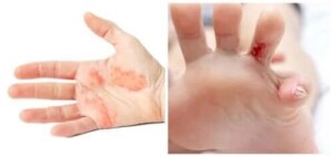 Eczema dishidrotică: tot ce trebuie să știi