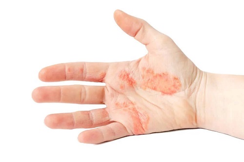 Eczema dishidrotică pe mână