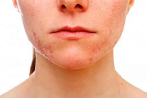 Fată care nu cunoaște cauzele acneei conglobate