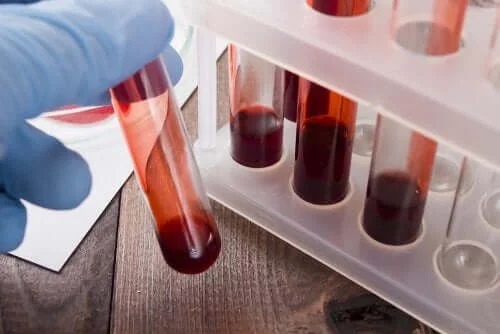 Medic care face analize pentru a descoperi tratamentul artritei septice