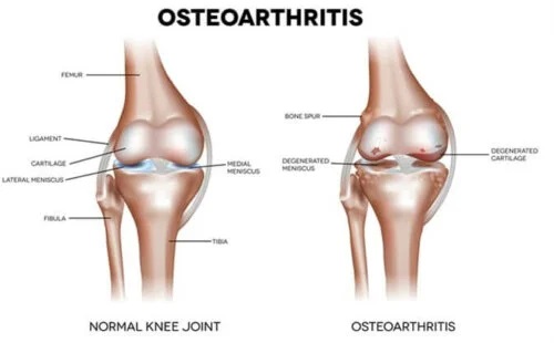 Osteoartrita afectează oasele