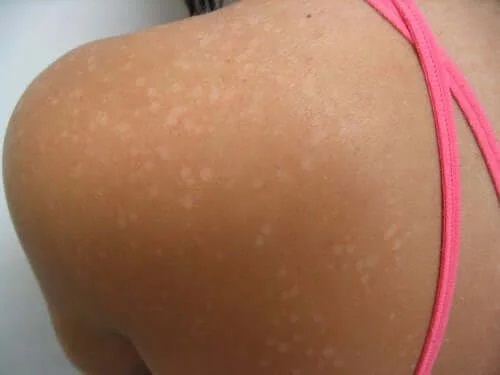 Prevenirea bolilor de piele care apar pe spate