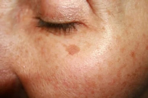 Prevenirea bolilor de piele la nivelul feței