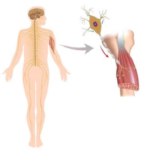 Tulburările neuromusculare afectează mușchii și nervii