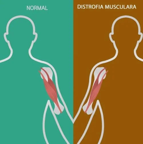 Tulburările neuromusculare: semne și simptome
