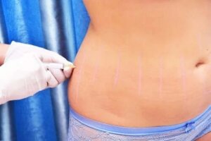 Ce este și care sunt utilizările lipoterapiei?