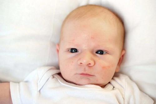 Bebeluș cu acnee