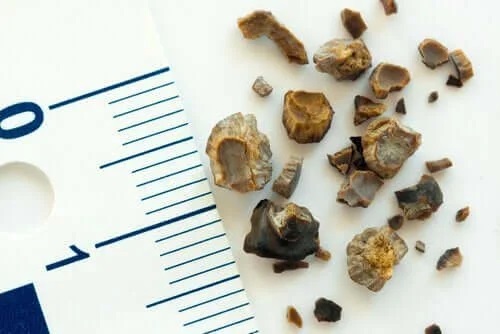 Calculi renali