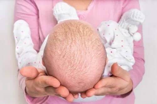 Bebeluș afectat de crusta de lapte